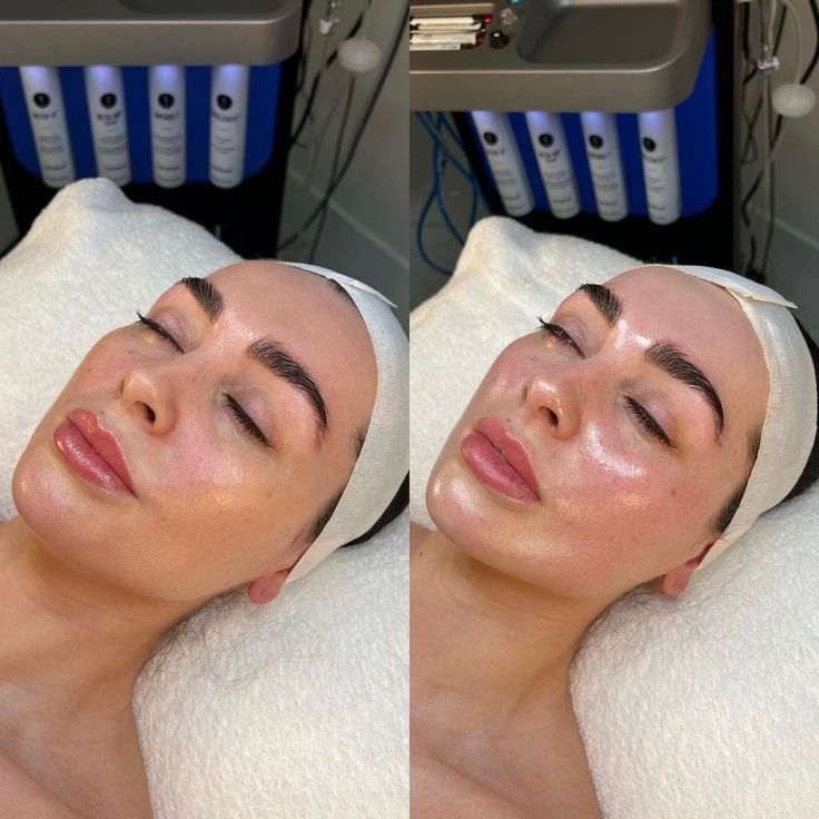 Cilt Bakımı & Ton Eşitleme - Özlem Beauty önce sonra