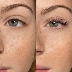 Melasma & Cilt Yenileme - Özlem Beauty önce sonra
