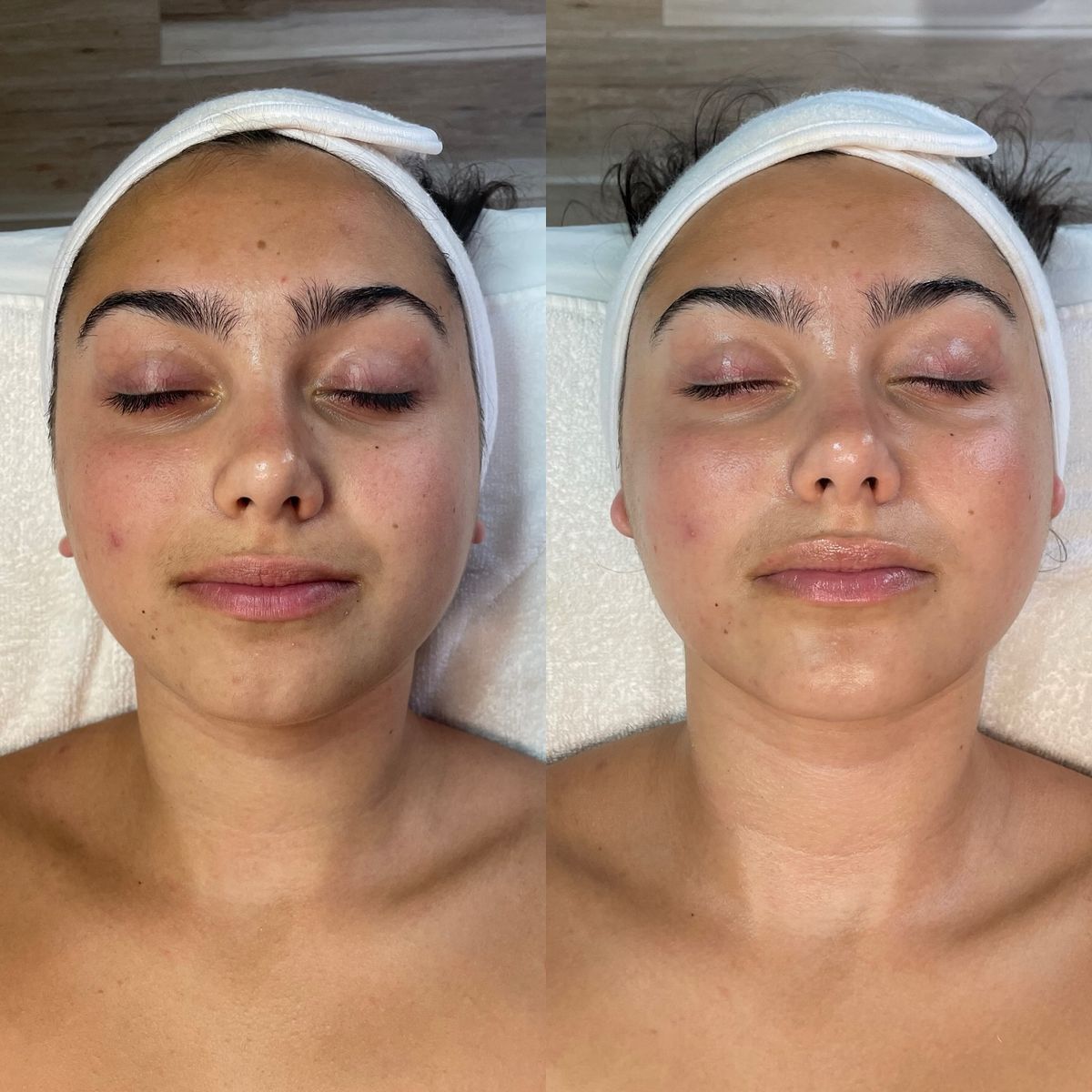 Cilt Yenileme & Leke Tedavisi - Özlem Beauty önce sonra