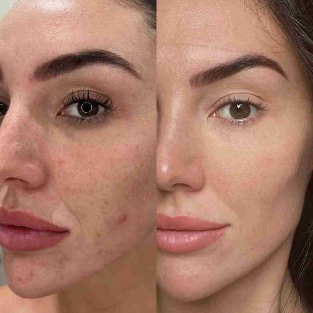 Cilt Gençleştirme Protokolü - Özlem Beauty önce sonra