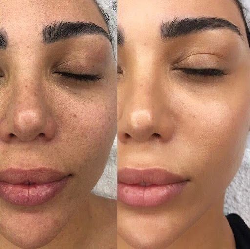 HydraFacial & Cilt Işıltısı - Özlem Beauty önce sonra